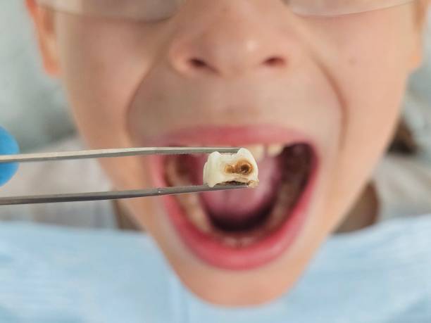 Best Emergency Root Canal Therapy in Algonquin, MD